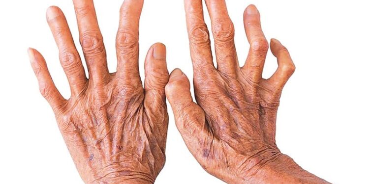 नेपालमा २५ सयभन्दा बढी कुष्ठरोगका नयाँ बिरामी, कुन प्रदेशमा कति ?