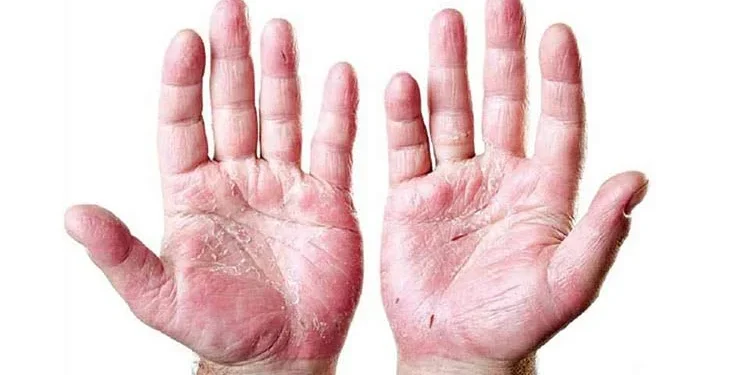 कुष्ठरोगको नयाँ बिरामीमध्ये १ सय ८९ जना फरक क्षमताका